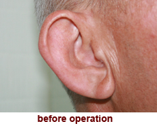 plastic-surgery-prominent-ear 